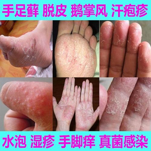 紹興手足癬_手足癬有什么表現(xiàn)_紹興治療手足癬-- 紹興市越城區(qū)銘甲灰指甲